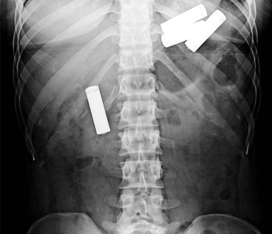 صور: اغرب 10 اشياء وجدت في المعدة البشرية: موبايل، قنبلة، مفتاح، مقص وسكاكين! صورة رقم 2 صور: اغرب 10 اشياء وجدت في المعدة البشرية: موبايل، قنبلة، مفتاح، مقص وسكاكين! صورة رقم 2