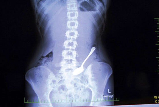 صور: اغرب 10 اشياء وجدت في المعدة البشرية: موبايل، قنبلة، مفتاح، مقص وسكاكين! صورة رقم 5 صور: اغرب 10 اشياء وجدت في المعدة البشرية: موبايل، قنبلة، مفتاح، مقص وسكاكين! صورة رقم 5