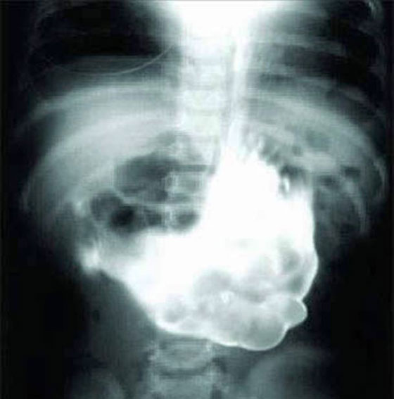 صور: اغرب 10 اشياء وجدت في المعدة البشرية: موبايل، قنبلة، مفتاح، مقص وسكاكين! صورة رقم 10 صور: اغرب 10 اشياء وجدت في المعدة البشرية: موبايل، قنبلة، مفتاح، مقص وسكاكين! صورة رقم 10