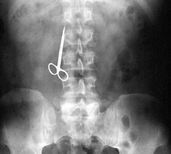 صور: اغرب 10 اشياء وجدت في المعدة البشرية: موبايل، قنبلة، مفتاح، مقص وسكاكين! صورة رقم 7 صور: اغرب 10 اشياء وجدت في المعدة البشرية: موبايل، قنبلة، مفتاح، مقص وسكاكين! صورة رقم 7