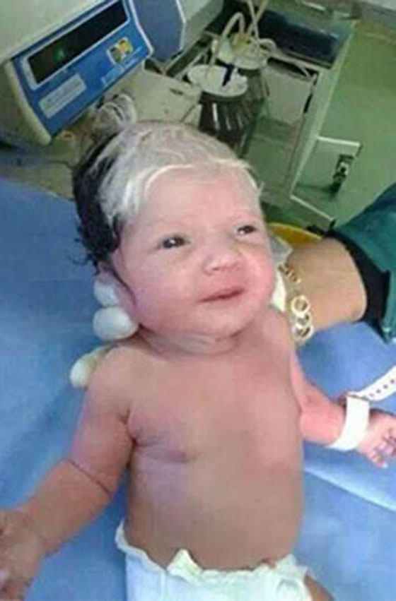  بالصورة.. ولادة طفل سوري بشعر ابيض (شايب) صورة رقم 1