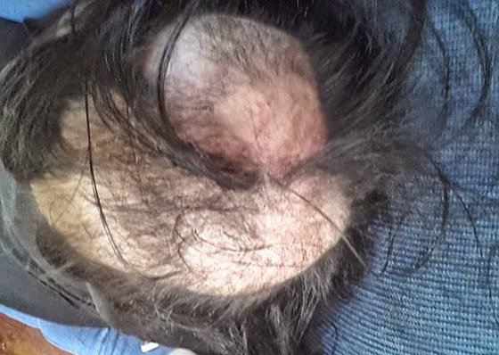 فتاة تعاني من اضطراب نتف الشعر تستيقظ لتجد نفسها صلعاء صورة رقم 4 فتاة تعاني من اضطراب نتف الشعر تستيقظ لتجد نفسها صلعاء صورة رقم 4
