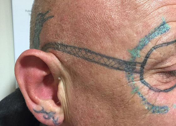 رجل ينام سكرانا ليفاجأ صباحا بوشم محرج على عرض وجهه صورة رقم 1