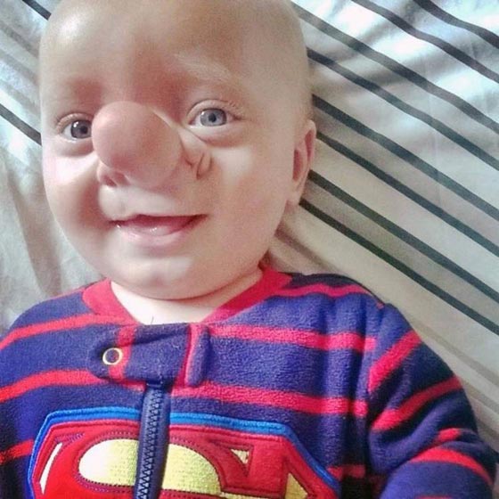 صور طفل دماغه في انفه.. اشبه ما يكون ببينوكيو صورة رقم 4 صور طفل دماغه في انفه.. اشبه ما يكون ببينوكيو صورة رقم 4