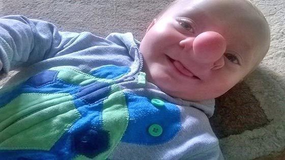 صور طفل دماغه في انفه.. اشبه ما يكون ببينوكيو صورة رقم 5 صور طفل دماغه في انفه.. اشبه ما يكون ببينوكيو صورة رقم 5