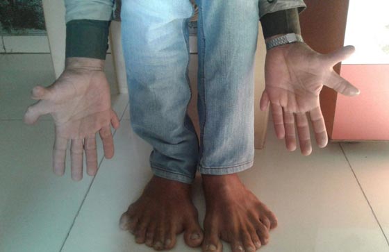 هندي يدخل غينيس بـ 14 اصبعا في يديه ومثلها في قدميه.. شاهد صورة رقم 2