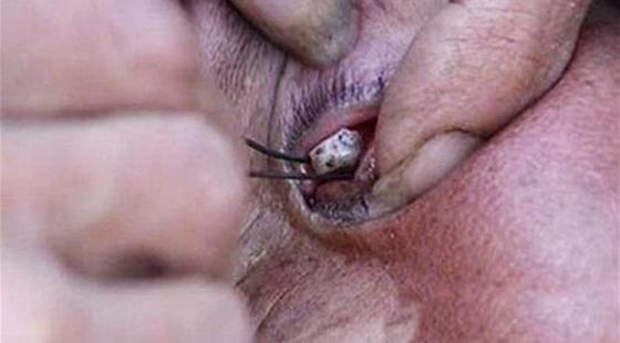 فيديو وصور امرأة صينية تذرف حجارة كبيرة من عينيها بدل الدموع صورة رقم 1