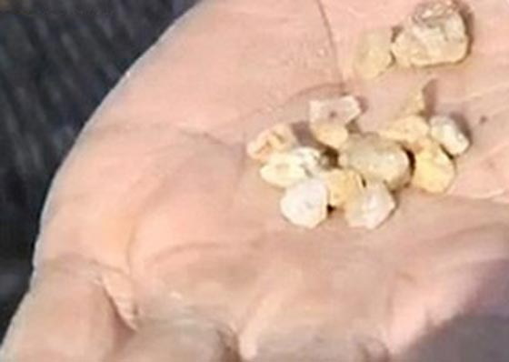 فيديو وصور امرأة صينية تذرف حجارة كبيرة من عينيها بدل الدموع صورة رقم 2