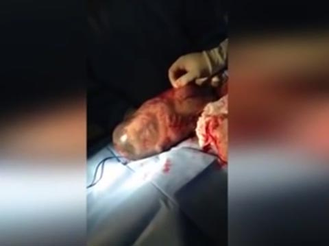 فيديو مثير.. لحظة خروج مولود من كيسه الامنيوسي صورة رقم 1