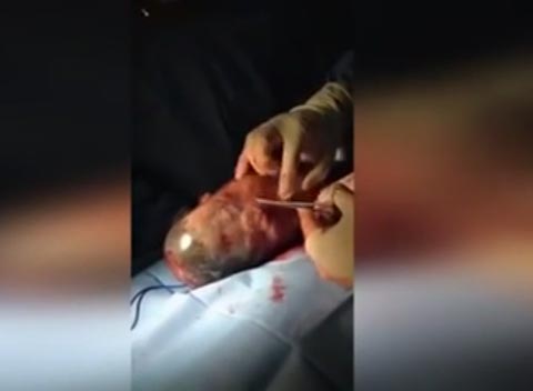 فيديو مثير.. لحظة خروج مولود من كيسه الامنيوسي صورة رقم 2