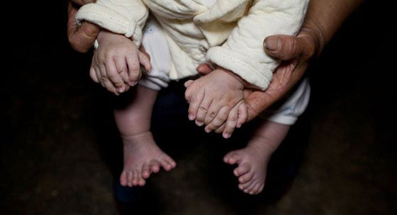  حالة نادرة.. طفل صيني يولد مع 31 اصبعا صورة رقم 7