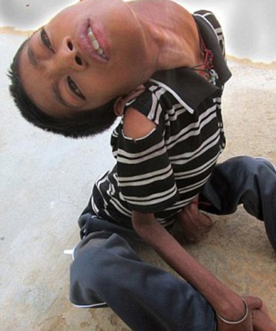 صور طفل غير قابل للشنق.. يحني عنقه بزاوية 30 درجة صورة رقم 1