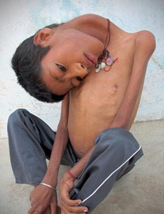 صور طفل غير قابل للشنق.. يحني عنقه بزاوية 30 درجة صورة رقم 4