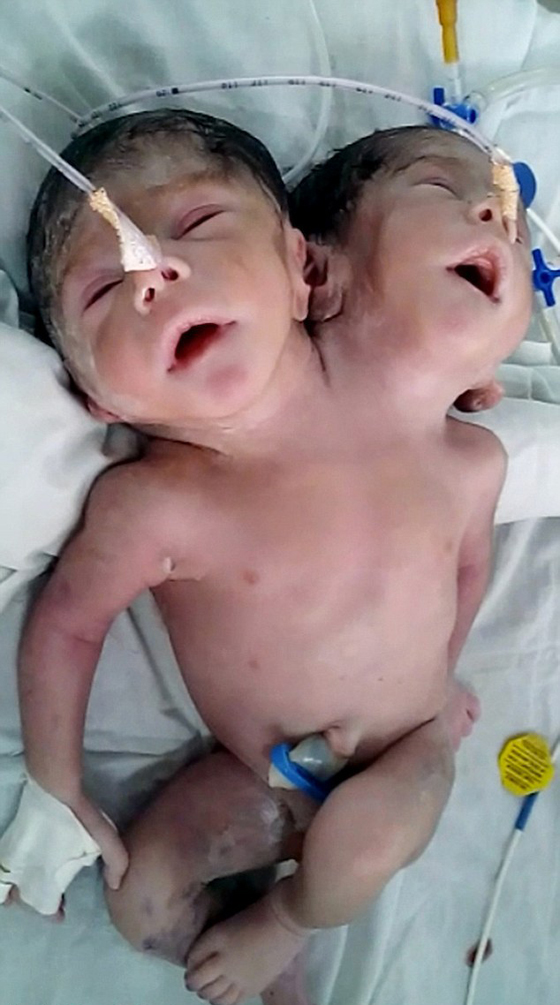 وصفها الاطباء بالمعجزة.. ولادة طفل برأسين لكنه فارق الحياة بعد ساعات صورة رقم 2