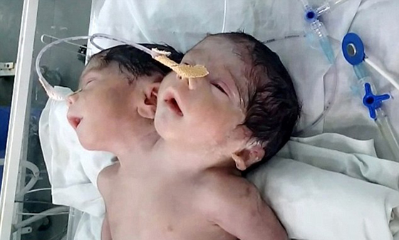 وصفها الاطباء بالمعجزة.. ولادة طفل برأسين لكنه فارق الحياة بعد ساعات صورة رقم 3