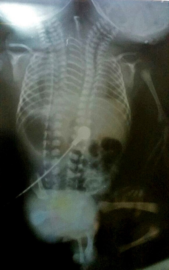وصفها الاطباء بالمعجزة.. ولادة طفل برأسين لكنه فارق الحياة بعد ساعات صورة رقم 5