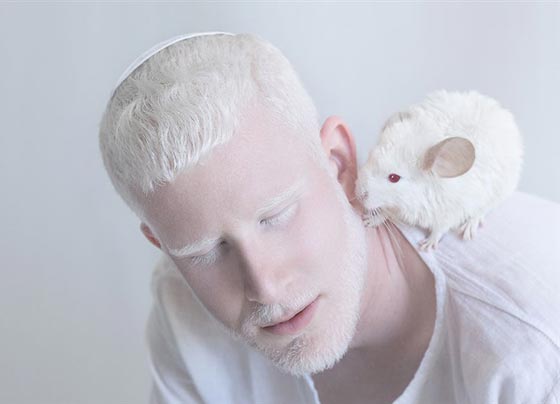 صور مذهلة: اشخاص ألبينو (يعانون من المهاق) في 11 لقطة ابهرت االجميع صورة رقم 1 صور مذهلة: اشخاص ألبينو (يعانون من المهاق) في 11 لقطة ابهرت االجميع صورة رقم 1