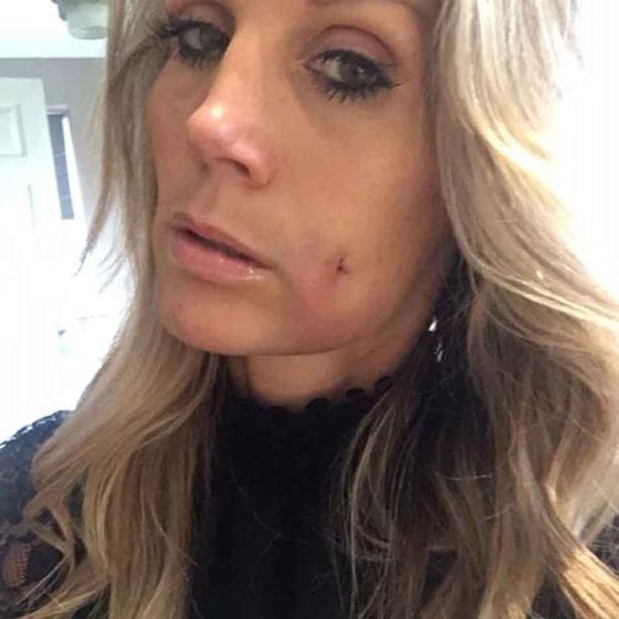 جنون ام.. غارت من غمازات ابنها فأجرت عملية تجميل لـ (خرم خديها)! صورة رقم 3 جنون ام.. غارت من غمازات ابنها فأجرت عملية تجميل لـ (خرم خديها)! صورة رقم 3