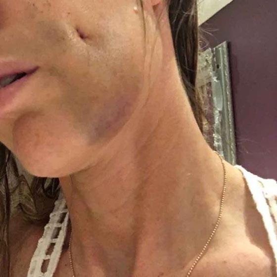 جنون ام.. غارت من غمازات ابنها فأجرت عملية تجميل لـ (خرم خديها)! صورة رقم 4 جنون ام.. غارت من غمازات ابنها فأجرت عملية تجميل لـ (خرم خديها)! صورة رقم 4