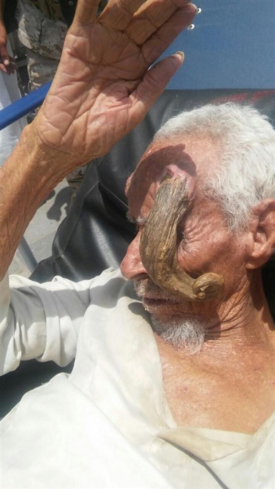 رجل يمني يعيش مع قرن شيطاني في جبينه.. صور صورة رقم 3