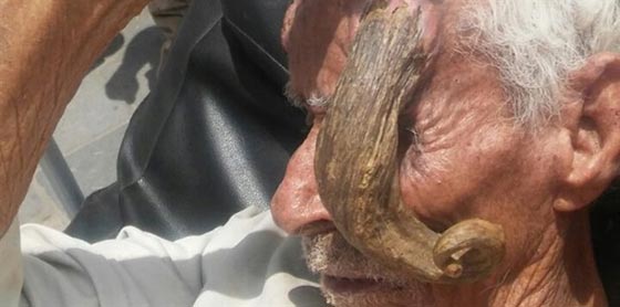 رجل يمني يعيش مع قرن شيطاني في جبينه.. صور صورة رقم 4