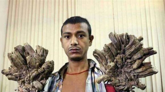 بعد 16 عملية جراحية.. الرجل الشجرة يعود الى طبيعته! صور صورة رقم 5