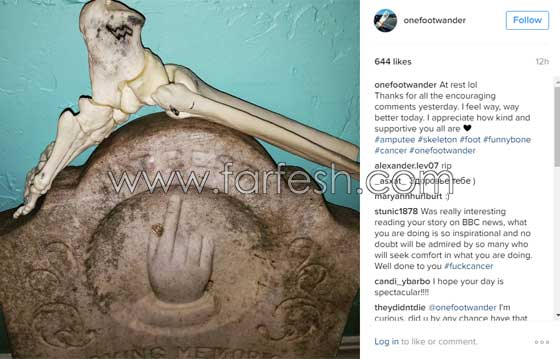 فتاة تعرض عظام ساقها المبتورة في كل مكان وتنشرها على انستغرام صورة رقم 3
