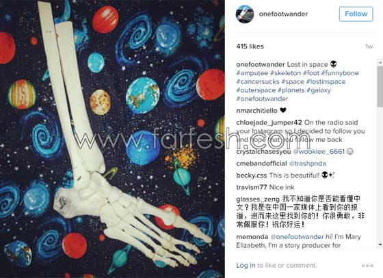 فتاة تعرض عظام ساقها المبتورة في كل مكان وتنشرها على انستغرام صورة رقم 13