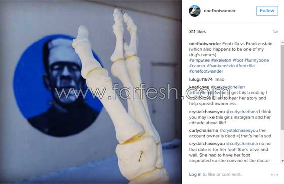 فتاة تعرض عظام ساقها المبتورة في كل مكان وتنشرها على انستغرام صورة رقم 15