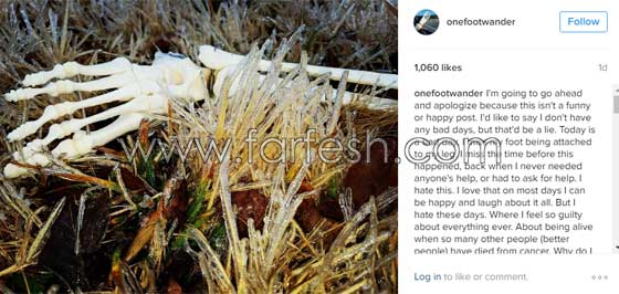 فتاة تعرض عظام ساقها المبتورة في كل مكان وتنشرها على انستغرام صورة رقم 4