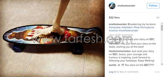 فتاة تعرض عظام ساقها المبتورة في كل مكان وتنشرها على انستغرام صورة رقم 5