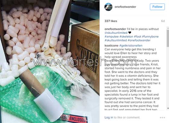 فتاة تعرض عظام ساقها المبتورة في كل مكان وتنشرها على انستغرام صورة رقم 11