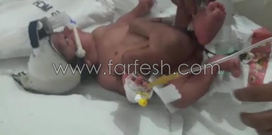 ولادة طفل باربعة ارجل واعضاء تناسلية مزدوجة في الهند.. صور صورة رقم 1 ولادة طفل باربعة ارجل واعضاء تناسلية مزدوجة في الهند.. صور صورة رقم 1