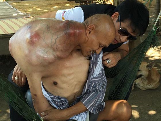 شاهدوا.. معلم يتابع مهنته بالرغم من إصابته بورم سرطاني ضخم صورة رقم 2