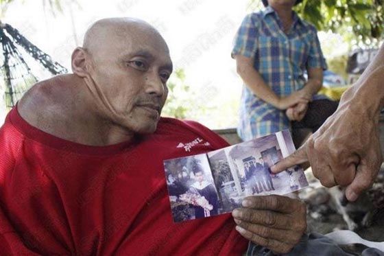 شاهدوا.. معلم يتابع مهنته بالرغم من إصابته بورم سرطاني ضخم صورة رقم 3