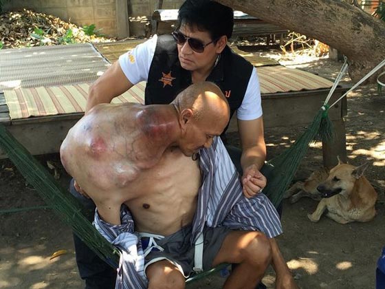 شاهدوا.. معلم يتابع مهنته بالرغم من إصابته بورم سرطاني ضخم صورة رقم 4