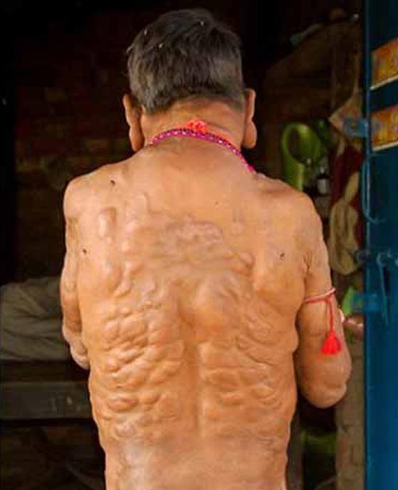 صور غريبة جدا: مرض نادر يحوّل صاحبه إلى (شبح)! صورة رقم 5