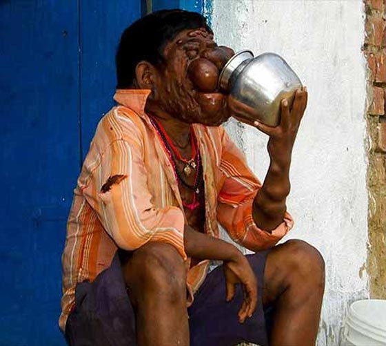 صور غريبة جدا: مرض نادر يحوّل صاحبه إلى (شبح)! صورة رقم 7