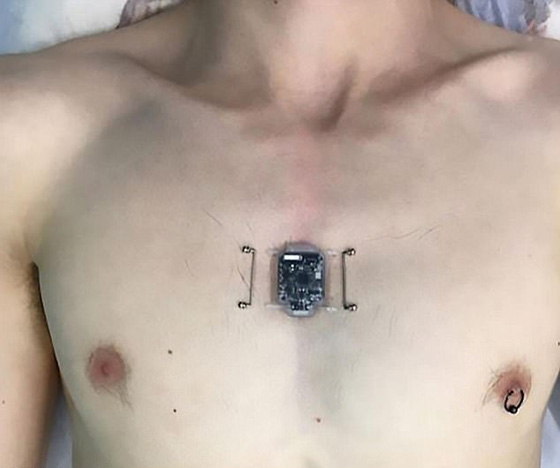جنون التكنولوجيا.. زرع بوصلة في صدره بحثا عن الحاسة السادسة! صورة رقم 1