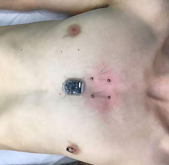جنون التكنولوجيا.. زرع بوصلة في صدره بحثا عن الحاسة السادسة! صورة رقم 5