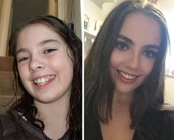صور مدهشة لأشخاص قبل وبعد استخدام تقويم الأسنان صورة رقم 13