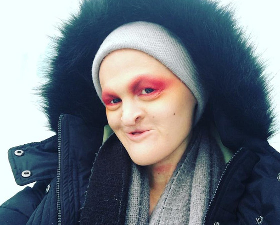 اجرت 40 عملية تجميل بسبب تشوهات من مرض نادر والنتيجة مذهلة! صورة رقم 2
