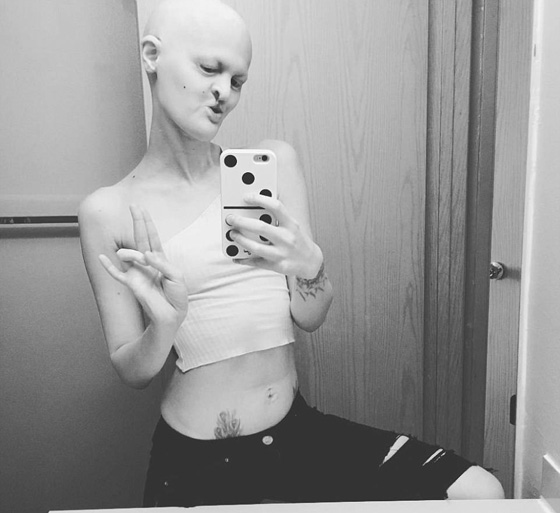 اجرت 40 عملية تجميل بسبب تشوهات من مرض نادر والنتيجة مذهلة! صورة رقم 3