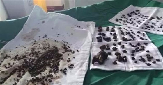 أغرب الأشياء وجدها الأطباء في أجساد المرضى.. من بينها 27 عدسة لاصقة صورة رقم 2