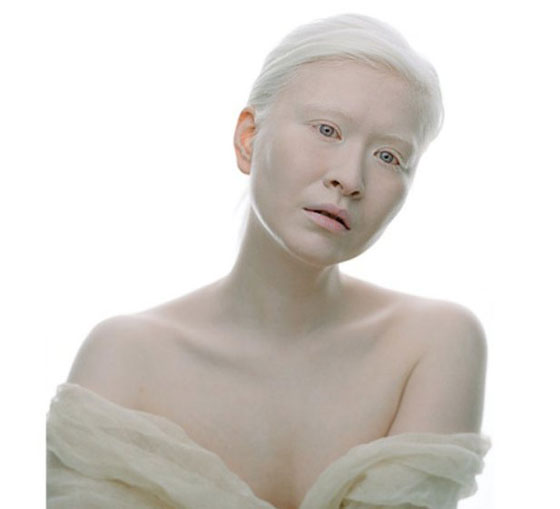 6 اشخاص جذبوا انتباه العالم بلون البشرة غير المألوف صورة رقم 2