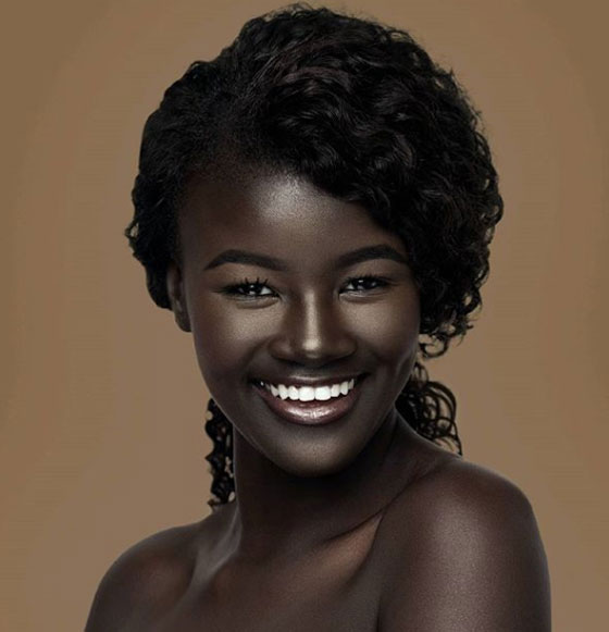 6 اشخاص جذبوا انتباه العالم بلون البشرة غير المألوف صورة رقم 6