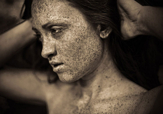 6 اشخاص جذبوا انتباه العالم بلون البشرة غير المألوف صورة رقم 4