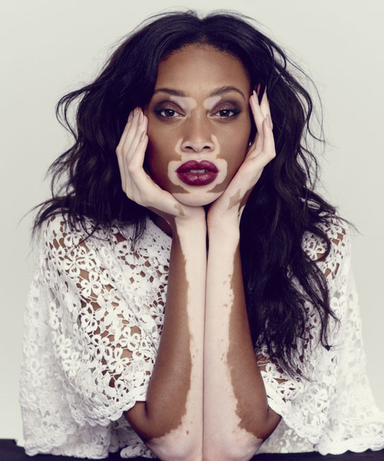 6 اشخاص جذبوا انتباه العالم بلون البشرة غير المألوف صورة رقم 5