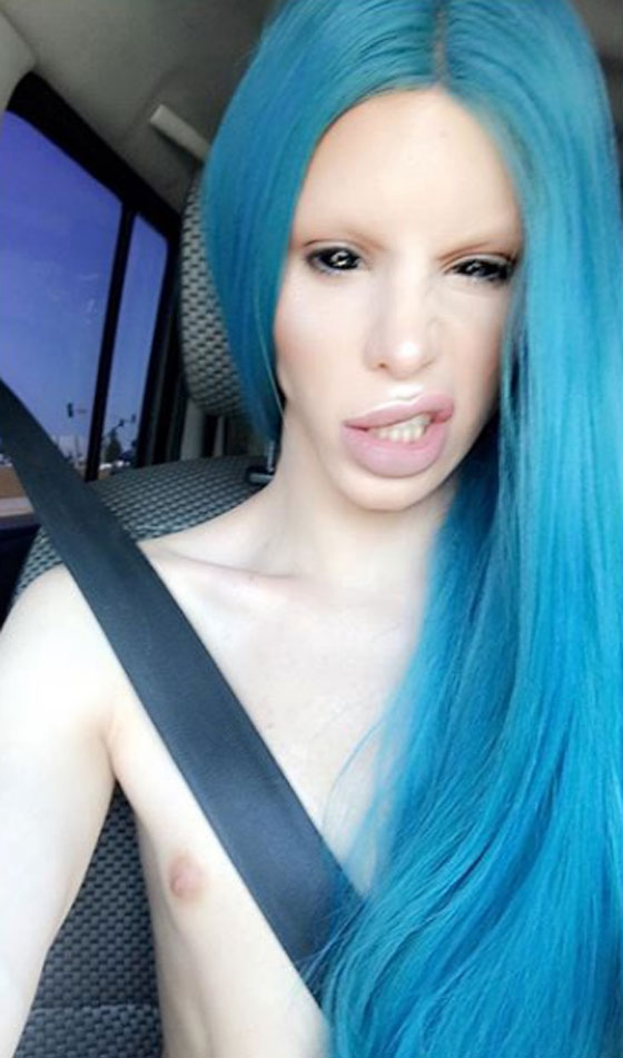 جنون عمليات التجميل.. شاب ينفق الاف الدولارات ليتحول لكائن فضائي  صورة رقم 16