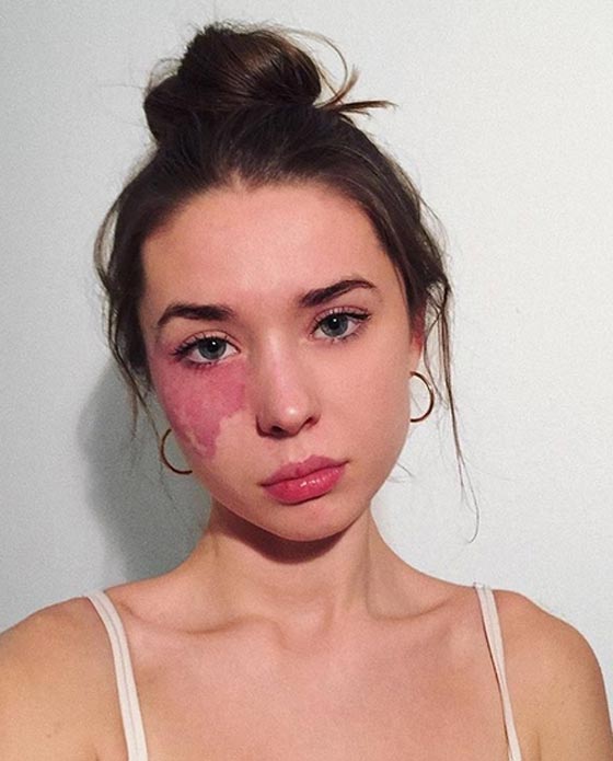 بالصور.. وحمة في وجه فتاة تثير ضجة عبر مواقع التواصل الإجتماعي صورة رقم 2